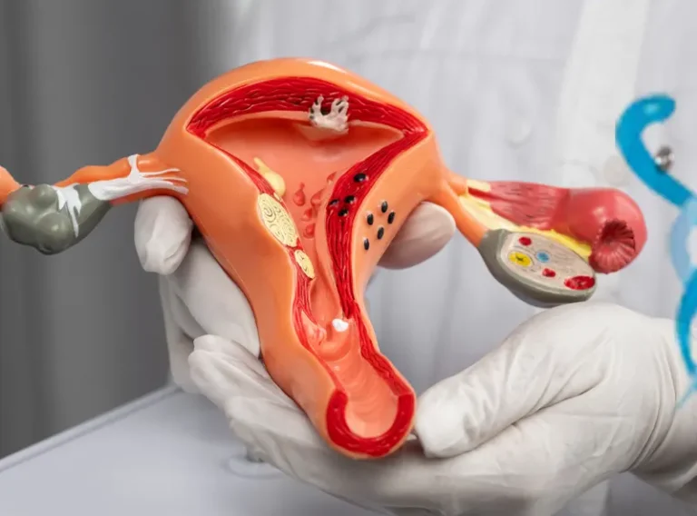 Derin İnfiltratif Endometriozis ve Çikolata Kistinin Diğer Organlara Yayılma Riski