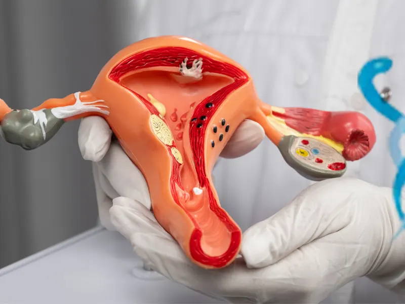 Derin İnfiltratif Endometriozis ve Çikolata Kistinin Diğer Organlara Yayılma Riski